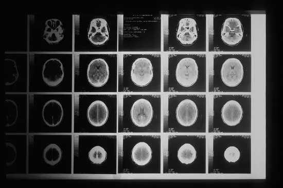 Motor Neurone Disease